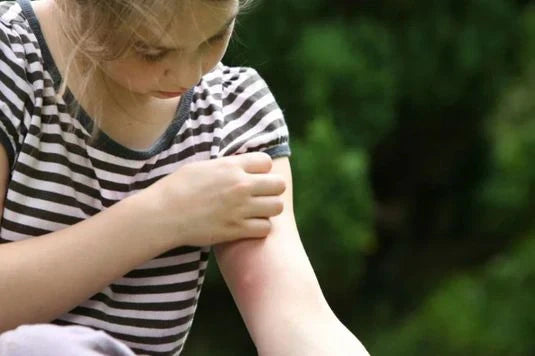 picada de mosquito no braço da criança